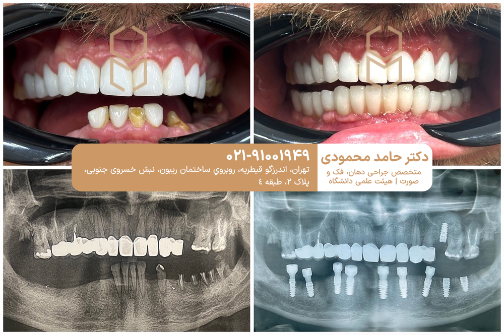 نمونه کار ایمپلنت فک پایین دکتر حامد محمودی