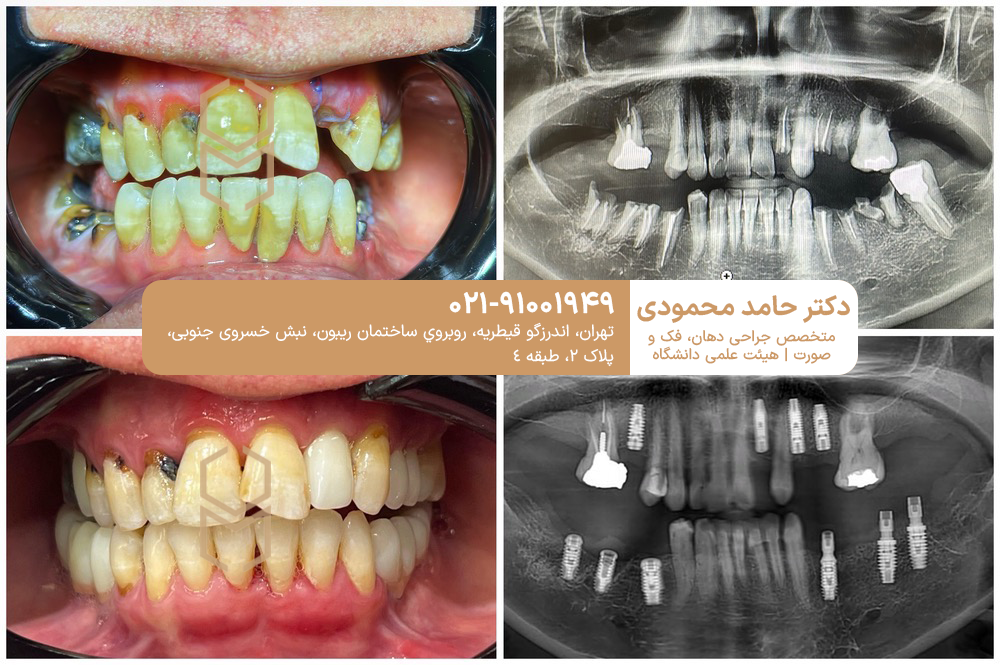 نمونه کار ایمپلنت دکتر حامد محمودی