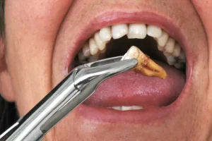 جراحی نهفتگی میانی در دندان های عقل